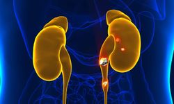 Böbrek taşının belirtilerini önemseyin!