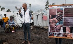 Kongo'da M çiçeği virüsü vaka sayısında artış