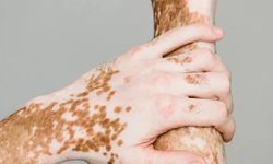 25 Haziran dünya vitiligo günü dolayısıyla farkındalık çağrısı