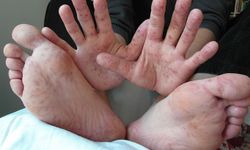 El, ayak ve ağız hastalığı çocuklar arasında çok hızlı yayılıyor