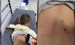 Mardin’de 7 yaşındaki Zeynep’e 3 sokak köpeği saldırdı 