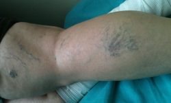  Sıcak havalarda varise dikkat!