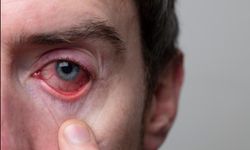 Yaz aylarında artış gösteren göz nezlesine dikkat!