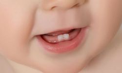 Diş çıkarma döneminde dikkat edilmesi gerekenler