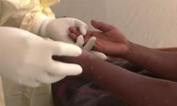 Gana'da M çiçeği vaka sayısında artış