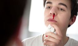 Sıcak havalarda burun kanamaları nedenlerine dikkat!