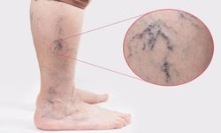 Şanlıurfa’da varis tedavisinde modern yöntemler uygulanıyor