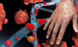 Gana'da M çiçeği vaka sayısında artış