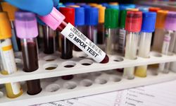 Gana'da M çiçeği virüsü vakalarında artış