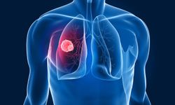 Göğüs Hast. Uzm. Dr. Tekeli: Kısa süreli kontroller akciğer kanserini erken teşhis ettiriyor