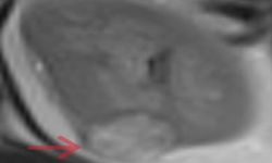 Laparoskopik Parsiyel Nefrektomi ile Ağrı'da bir ilk gerçekleştirildi!