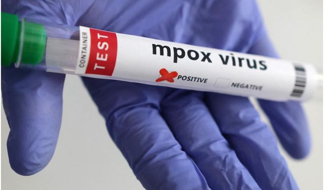 İngiltere’de mpox virüsünün yeni bir türü tespit edildi